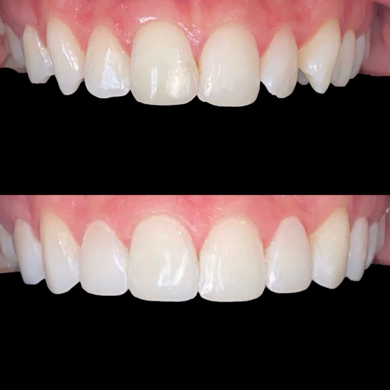 J Bell _ Composite Bonding (3)