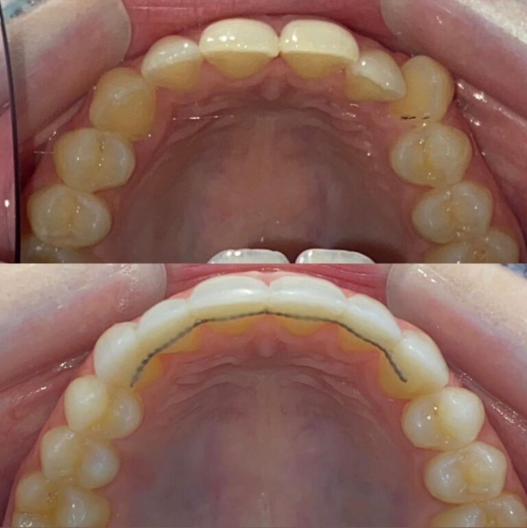 J Bell _ Invisalign & Fixed Retainer