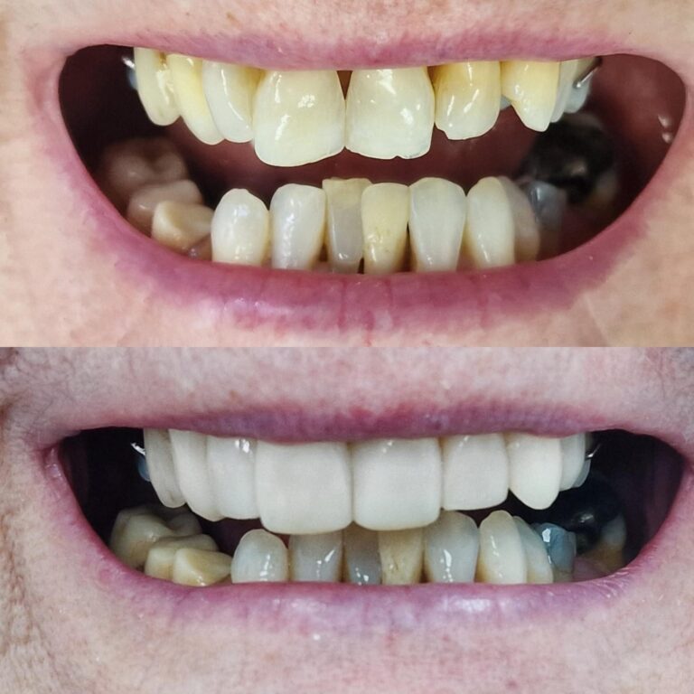 Saqib _ Composite Bonding