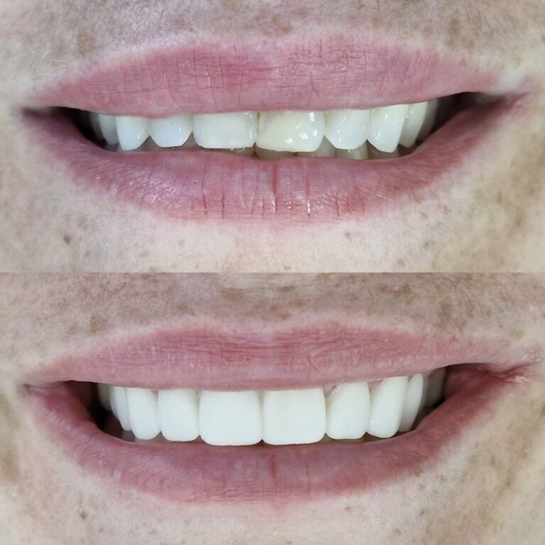 Saqib _ Porcelain Veneers